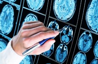 In UK il primo intervento assistito dall’AI per la rimozione di un tumore al cervello